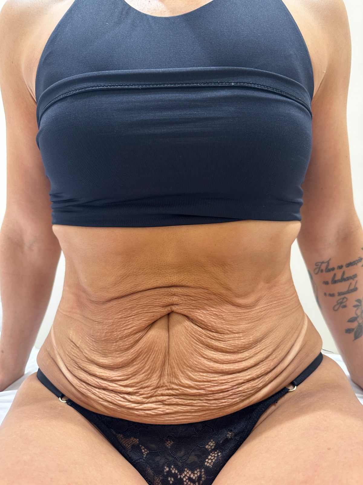 Antes — Firmeza abdominal