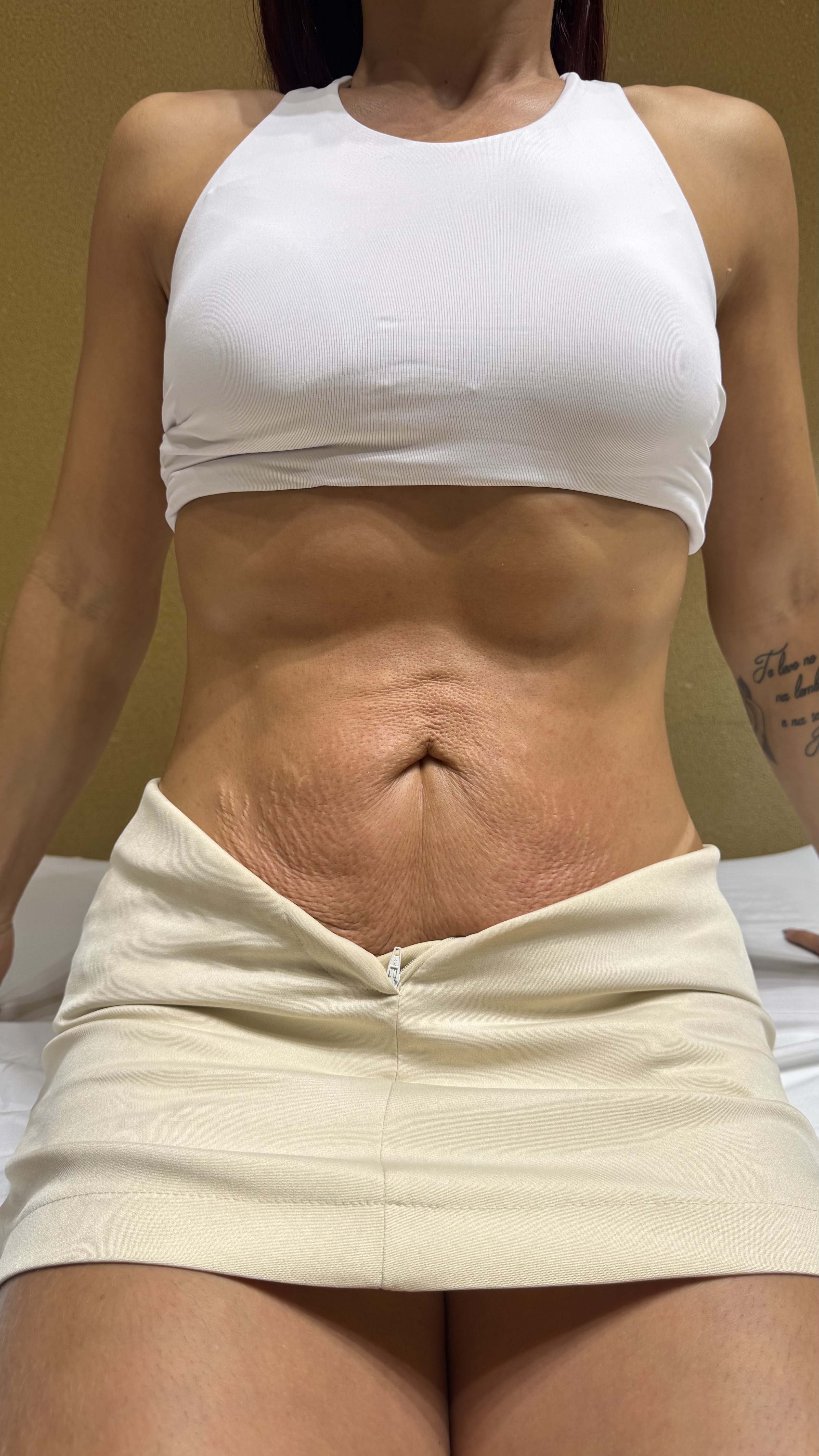 Depois — Firmeza abdominal
